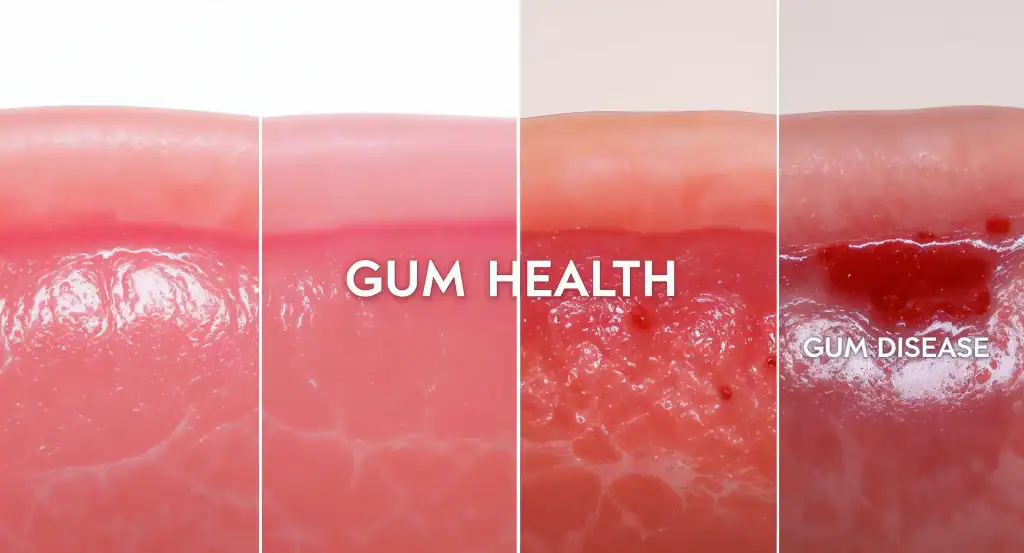 The 4 Stages of Gum Disease: Where Are You?